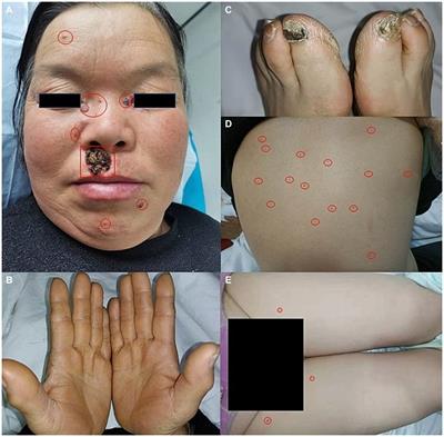 Case report: A novel PTCH1 frameshift mutation leading to nevoid basal cell carcinoma syndrome